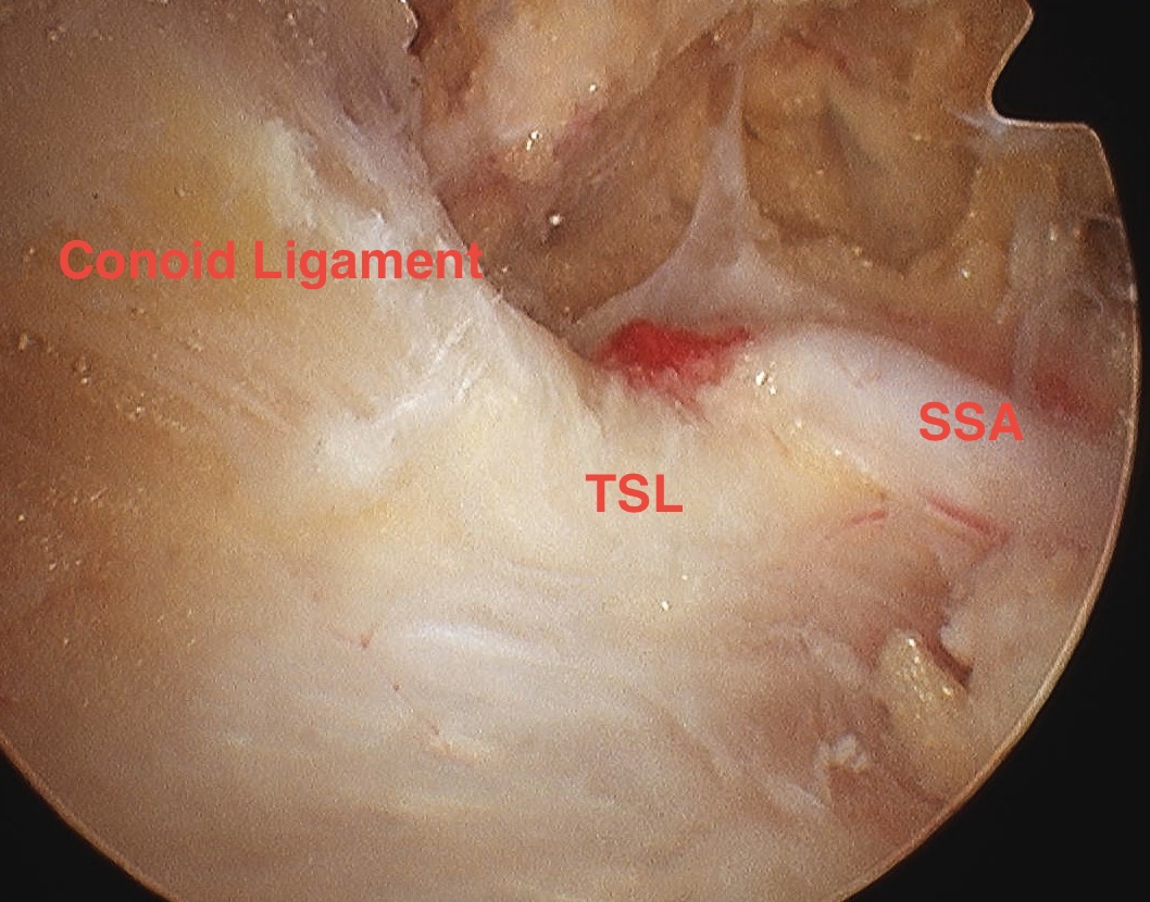 Suprascapular artery and transverse scapula ligament